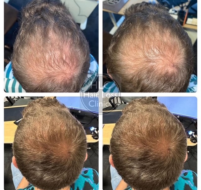 laser hair 2