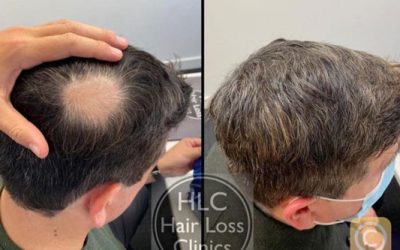 Alopecia & Other Hair Loss Conditions
