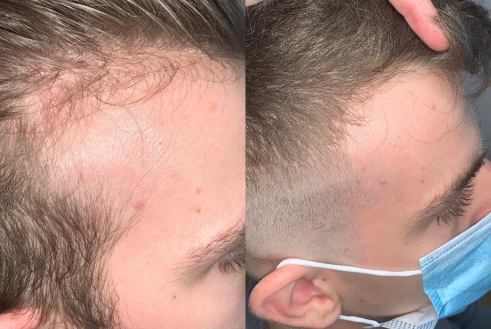 Minoxidil or Laser Hair Therapy?